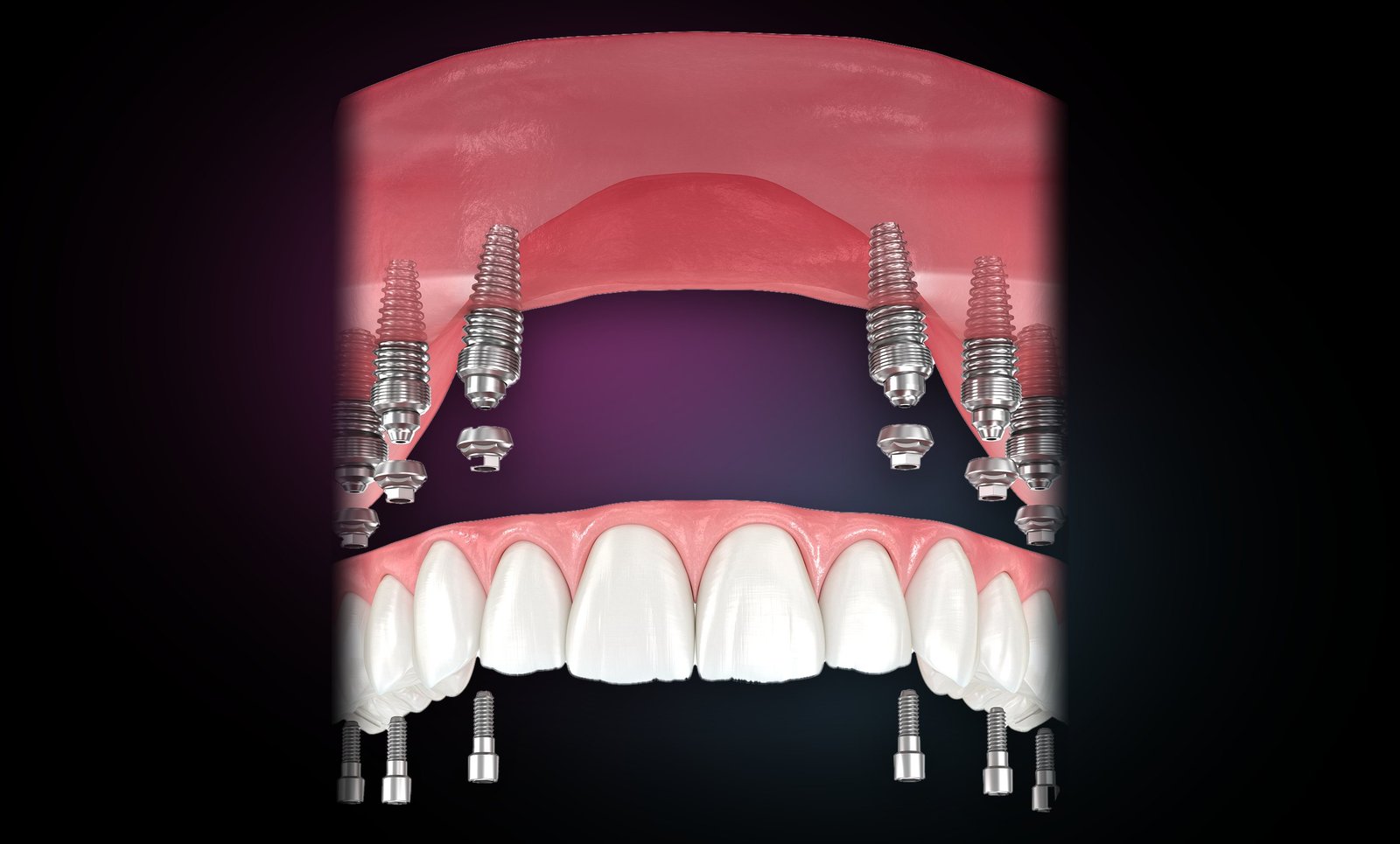 All-On-6: six implants supporting one fixed full-arch bridge