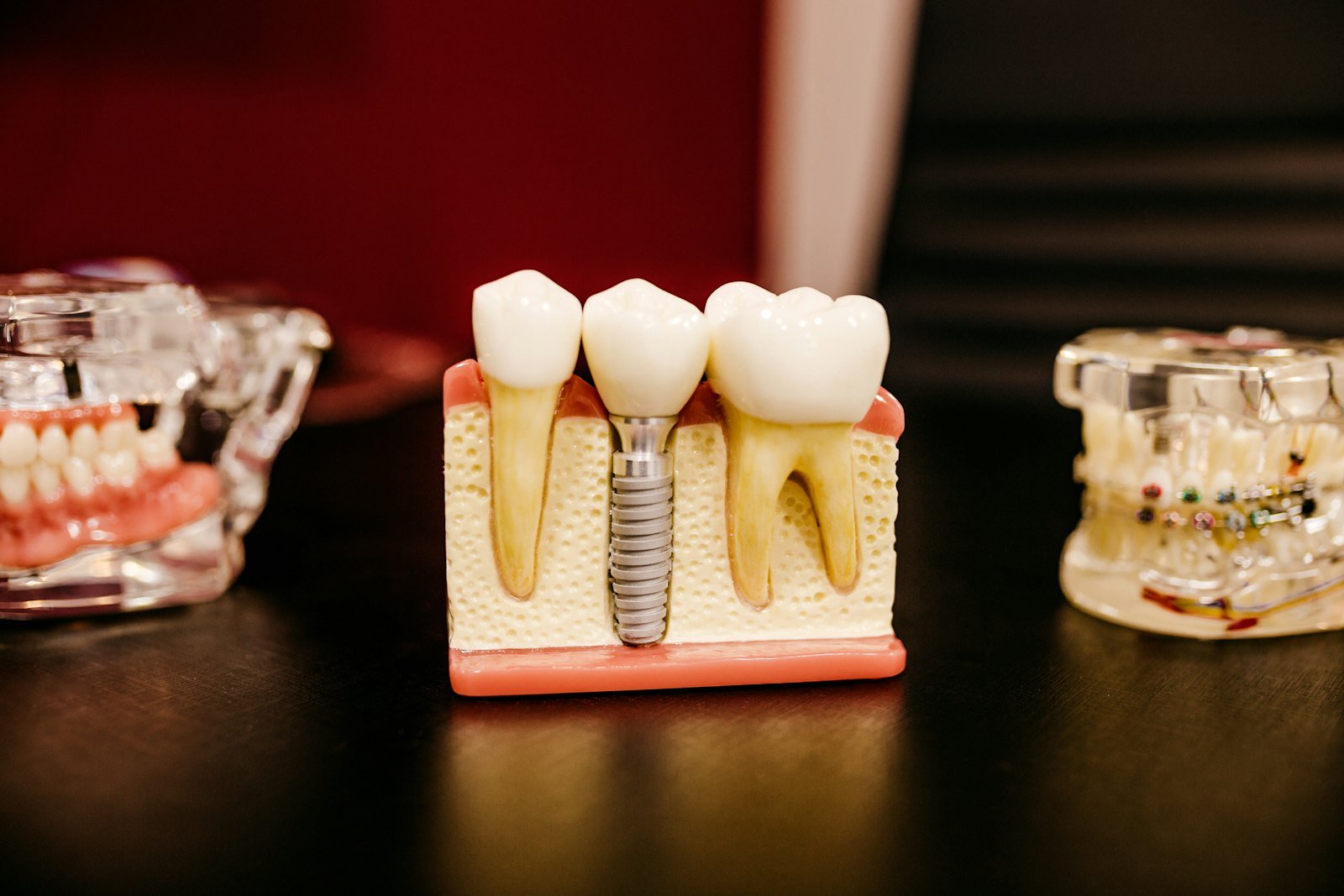 Dental implant model showing an implant between natural teeth