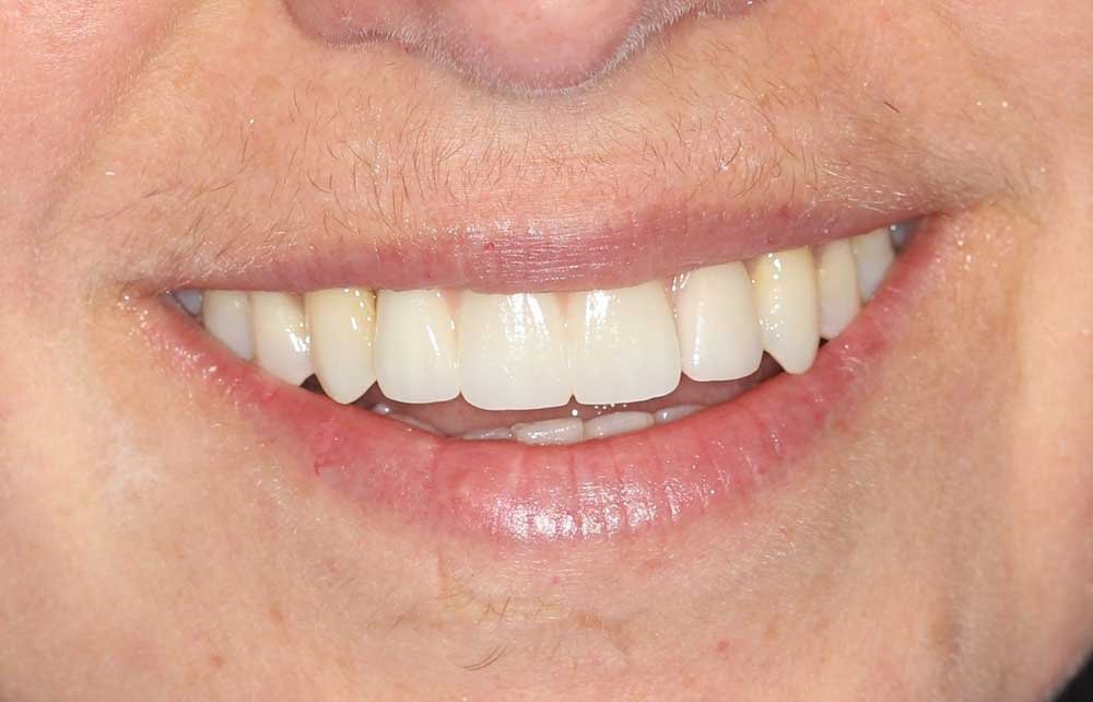 Upper-arch implant result