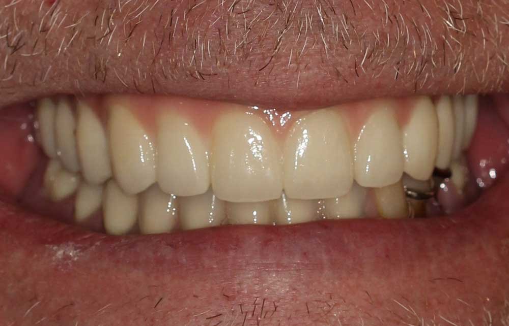 Multiple-tooth implant result