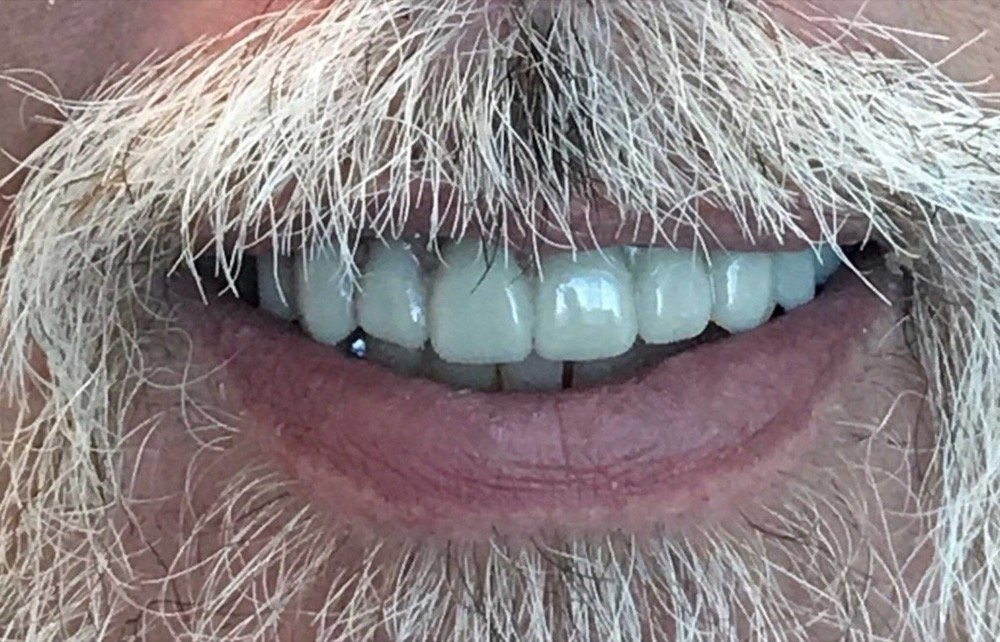 Full-arch implant result